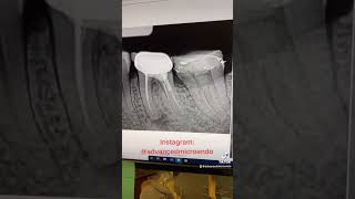 Two treatments under iv sedation dentist dentalprocedure rootcanal [upl. by Adrianna]