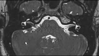 Vascular Loop in IAC [upl. by Donnamarie]