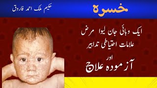 خسرہ کی روک تھام اور علاجA proven remedy for measles [upl. by Anika359]