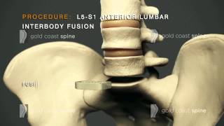 ALIF  Lumbar Spine Surgery [upl. by Raybourne170]