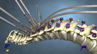 Correcting Kyphosis with the MESA Rail™ Deformity Spinal System [upl. by Stephens]