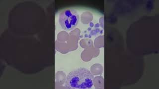 Hematology Patient with low platelets Part 1 [upl. by Ahsetal374]