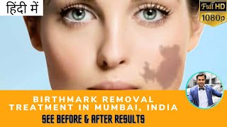 हिंदी में Birthmark Removal Laser amp Permanent Tattoo Removal Treatment in Mumbai Before After [upl. by Nilla]