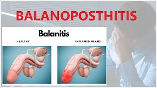 BALANOPOSTHITIS is a condition that affects the penis [upl. by Attem]