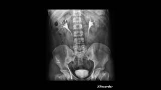 IVPIntravenous pyelogram [upl. by Rammaj647]