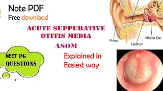 Acute Suppurative Otitis Media  ASOM  ENT  Easy explanation  Stages  Diagnosis  Management [upl. by Lennon]