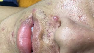 Acne Treament Under The Skin 050 [upl. by Naimad]