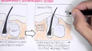 Acne Pathophsyiology [upl. by Agamemnon]