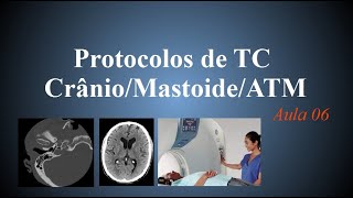 Curso de tomografia  Aula 6 Protocolos Crânio Mastoide ATM [upl. by Maer74]