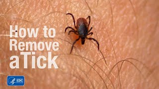 How to remove a tick [upl. by Isolda]