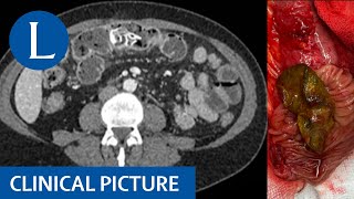 Migrated mesh obscures malignancy [upl. by Boone]