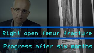 Femur fracture  Recovery Story amp Progress after six months femurfracture [upl. by Ahsini]