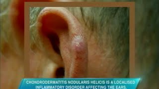 Doctors on TV What causes bumps behind the ears [upl. by Analahs]