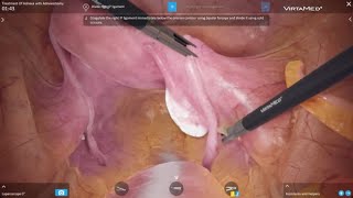 VirtaMed LaparoS™  Treatment of Adnexa with Adnexectomy [upl. by Maurreen]