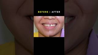 Braces for Gapped teeth 32 month Duration orthodontist braces dentist [upl. by Agbogla]