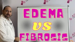 Edema VS Fibrosis Whats the Difference Liposuction Contour Irregularity  Lipo Lumps and Bumps [upl. by Annodal430]