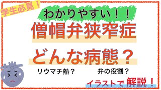 教科書をわかりやすく！「僧帽弁狭窄症ってどんな病態？」 [upl. by Naima544]