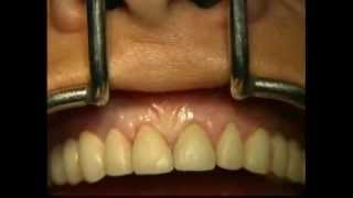 Gingival Surgery  Internal Bevel [upl. by Kristopher]