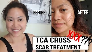 TCA Cross for Acne Scars Olive Skin Tone [upl. by Walters]