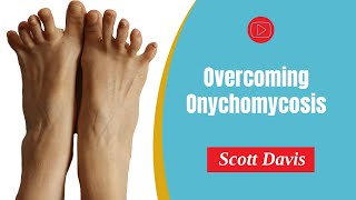 PDF Overcoming Onychomycosis [upl. by Creight]