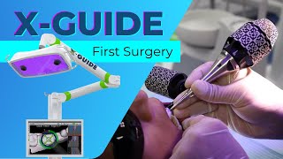 Our First XGuide Implant Surgery [upl. by Ylac]