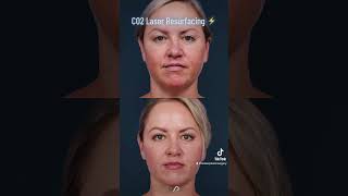 Revitalize Your Skin with CO2 Laser Resurfacing  The Ultimate Solution for Wrinkles and Scars [upl. by Settera]