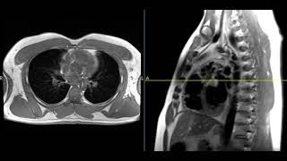 Palpable mass in anterior chest [upl. by Jasun]