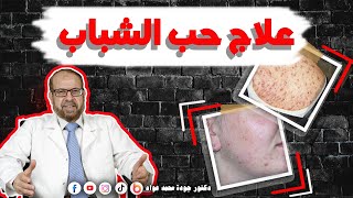 علاج حب الشباب  نتائج مذهلة [upl. by Ojillib]