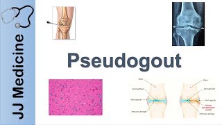 Pseudogout  Pathophysiology Symptoms and Treatment [upl. by Snebur]