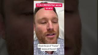 TCA trichloroacetic acid CROSS for Acne Ice Pick Scarring aesthetics skincare [upl. by Youlton]