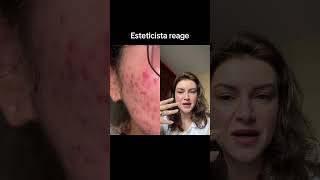 Esteticista reage a adesivo hidrocoloide [upl. by Nelav]