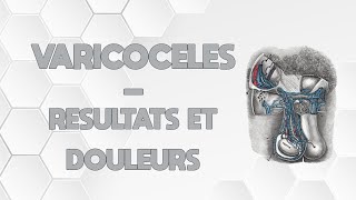 LES VARICOCÈLES  DOULEURS ET RESULTATS [upl. by Yruama]