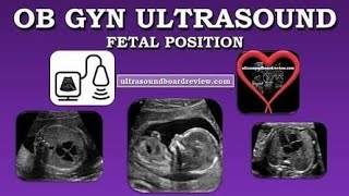 How To Determine Fetal Presentation and Fetal Situs Ultrasound [upl. by Laeira]