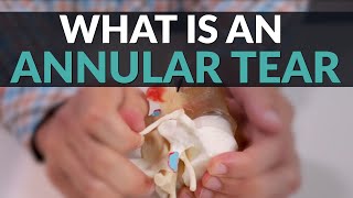 What is an Annular Tear and How Can You Find Relief [upl. by Niledam]