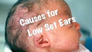 Quick Pediatrics Causes for Low set ears [upl. by Ajram]