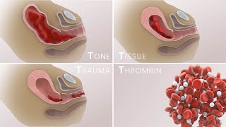 Management of Postpartum Hemorrhage PPH  Etiologies prevention treatment  TVASurg [upl. by Ronen]