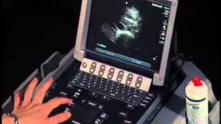 How To Abdominal Ultrasound  Aorta Measurements [upl. by Rockefeller463]