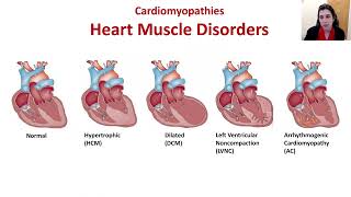 Hypertrophic Cardiomyopathy HCM Identifying Symptoms and Confirming the Diagnosis [upl. by Al]