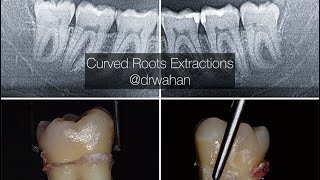 Erupted Wisdom Teeth with Curved Roots Extraction Video [upl. by Neerol251]