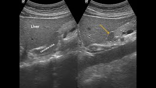 Papillary process of caudate lobe of liver 간 미상엽의 유두상돌기 [upl. by Yeoj266]