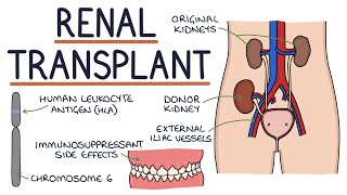 Understanding Kidney Transplants [upl. by Yellat]