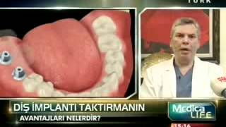 implant nedir  diş implantı taktırmanın avantajları nelerdir  Tanfer Klinik [upl. by Persian]