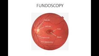 HOW TO DO FUNDOSCOPY OR OPHTHALMOSCOPY [upl. by Annayrb]