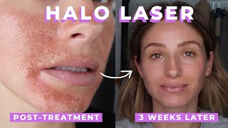 HALO LASER TREATMENT REVIEW  SKIN LASER [upl. by Si]