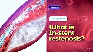 What is Instent restenosis [upl. by Peyton345]