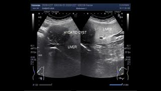 Hepatic Hydatid Cyst [upl. by Acimaj]