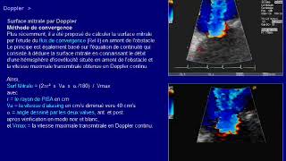 rétrécissement mitrale [upl. by Iram990]