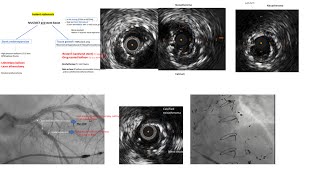 Instent restenosis types approach and cases [upl. by Adneral658]