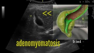 Fundal segmental adenomyomatosis of gallbladder ultrasound and color Doppler video [upl. by Keyser]