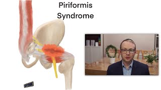 Piriformis Syndrome [upl. by Illa]